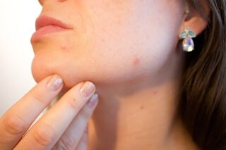 tratamiento_de_acne